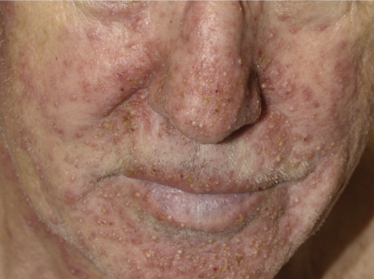 Side effects of topical corticosteroids on face